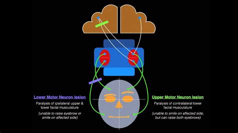 Upper And Lower Motor Neuron Lesion Physiopedia | Webmotor.org