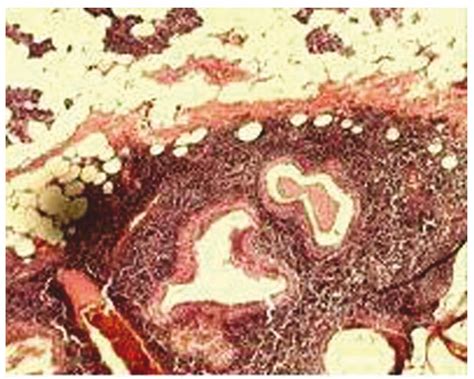 Scielo Brasil Synchronous Bilateral Warthin Tumors A Case Report