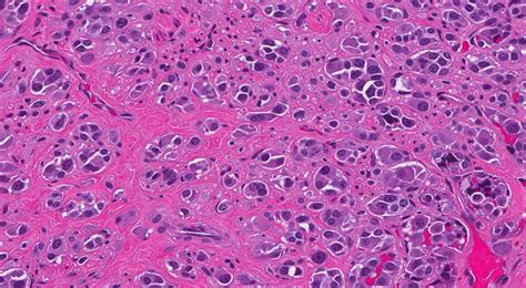 Medullary Thyroid Carcinoma Atlas Of Pathology