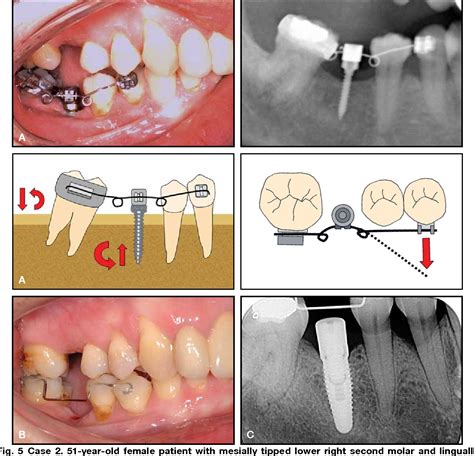 Figure From Preprosthetic Molar Uprighting Using Skeletal Anchorage