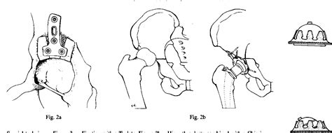 Figure From Superolateral Bone Grafting For Acetabular Deficiency In