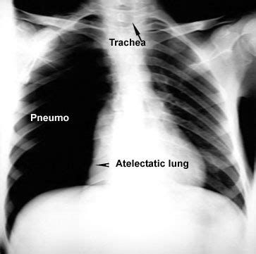 Pneumothorax Vs Atelectasis