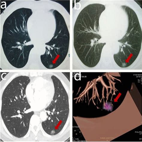 The CT scan of the patient. a Initial CT scan performed in July 2017. b ...