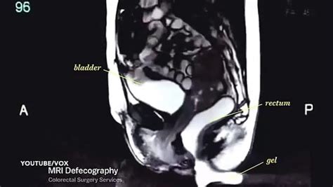 Amazing Mri Scan Video Captures Couple Having Sex Video Dailymotion