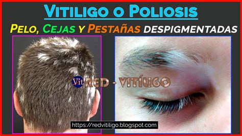 Pelo Cejas Y Pestañas Despigmentadas Vitiligo O Poliosis Y Cómo Tratarlo