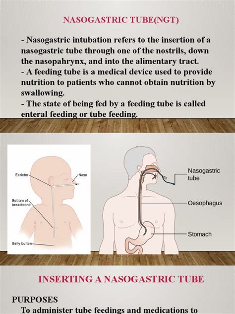 Nasogastric Tube Ngt Pdf