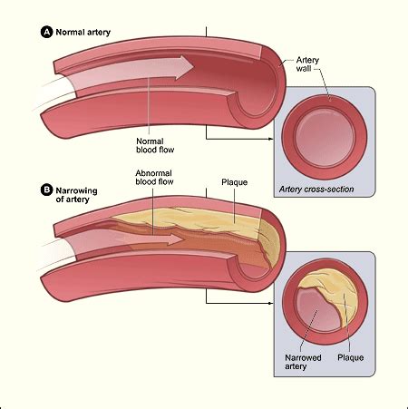 Cardiomiopatía isquémica Wikipedia la enciclopedia libre