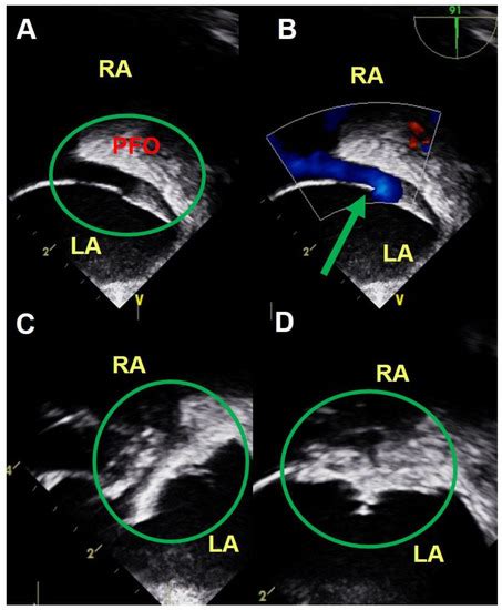 Medicina Free Full Text Comparison Of Intracardiac Echocardiography