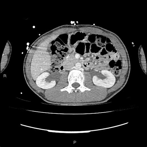 File Normal Dual Phase Trauma CT Chest Abdomen And Pelvis Radiopaedia