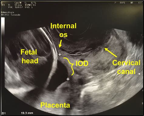 Pregnancy And Delivery Outcomes In Women With Persistent Versus