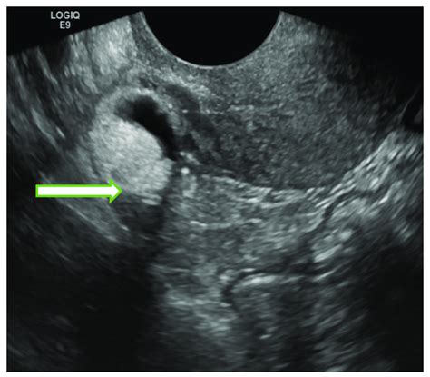 Transvaginal Ultrasound Image Of The Pelvis In A 55 Years Old Lady Download Scientific Diagram