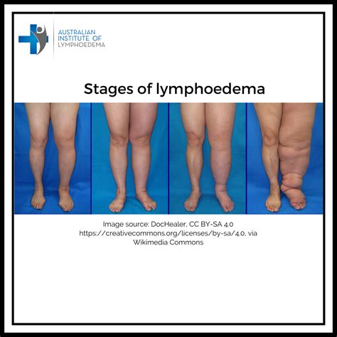 severity  lymphoedema defined australian institute