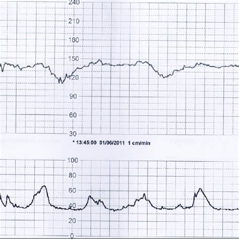 Fetal Cardiotocography Of The Patient During Admission Shows A Download Scientific Diagram