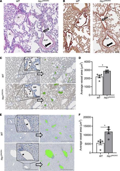 JCI Insight Neuropilin 1 Deficiency In Vascular Smooth Muscle Cells