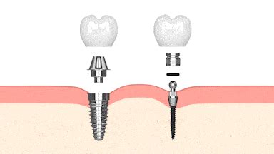 Implantes Convencionales Frente A Miniimplantes Dentales