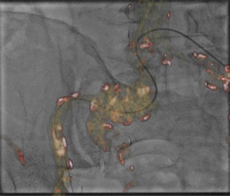 Tratamiento Endovascular De Aneurisma Il Aco Aislado Con Pr Tesis