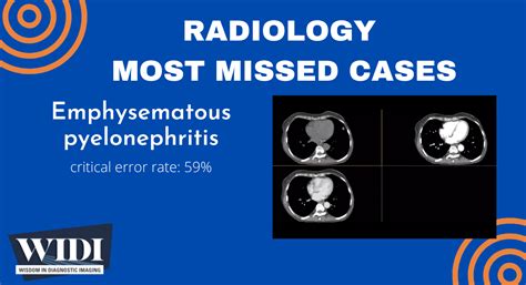 Most Missed Case Emphysematous Pyelonephritis Wisdom In Diagnostic Imaging College Of