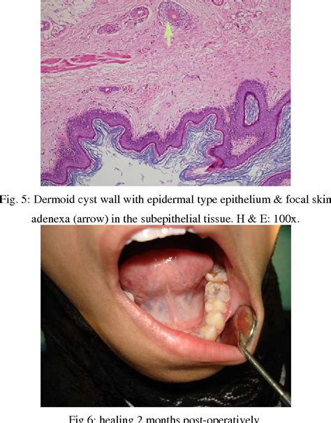 Sublingual Dermoid Cyst