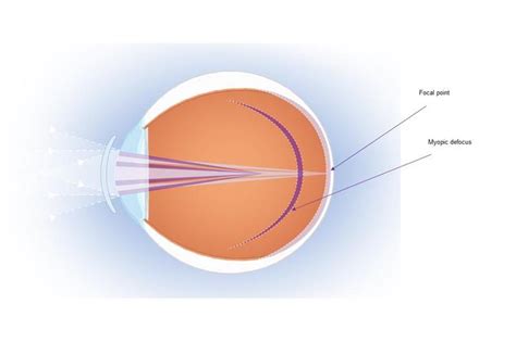 Clinical evaluation of MiSight 1 day contact lens for myopia control ...