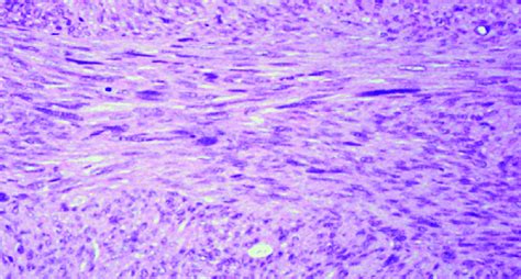 The Tumor Shows Proliferation Of Interlacing Fascicles Of Malignant