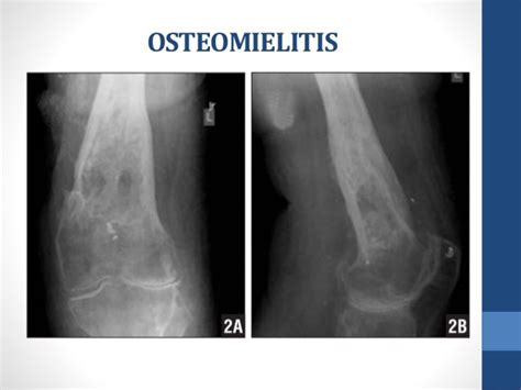 Osteomielitis Enfoque En Ortopedia