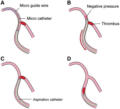 An Illustration Of The Sat A A Microcatheter Is Advanced Into The