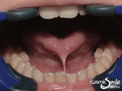 Frenectomy Before and After - Cosmic Smile Laser Dental