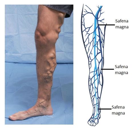 Deep Vein Thrombosis - Physiopedia