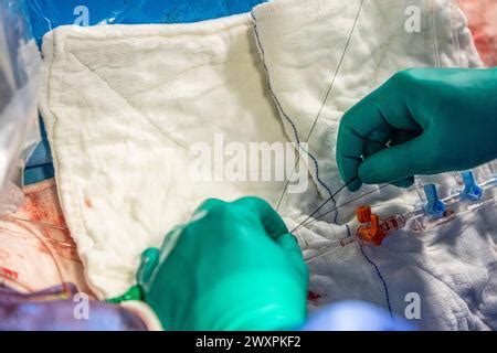 Proceso De Colocaci N De Stent De Coraz N En Sala De Operaciones