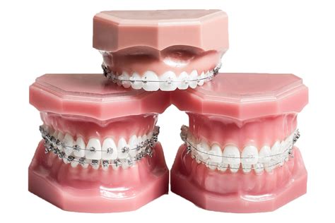 Self Ligating Braces Orthodontics At Bristol Dental Specialists