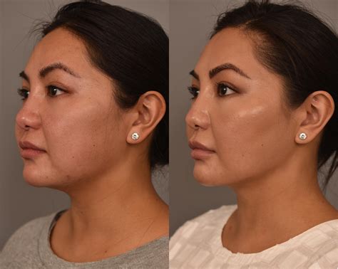 Cheek Liposuction Before And After Pictures Case 256 New York NY