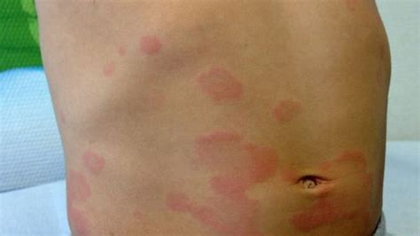 Urticaria Crónica Síntomas Causas Y Tratamiento