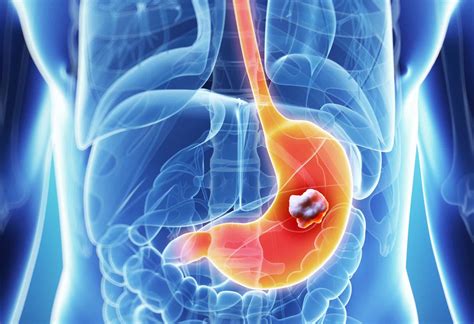 Stomach Cancer Causes Warning Signs And Treatment