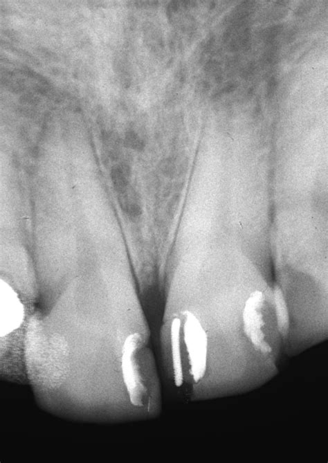 Intra Oral Radiograph Of The Maxillary Incisors At Time Of Nug