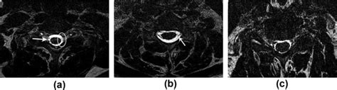 Axial T2 DRIVE MRI Myelography Is Highly Accurate In Diagnosing