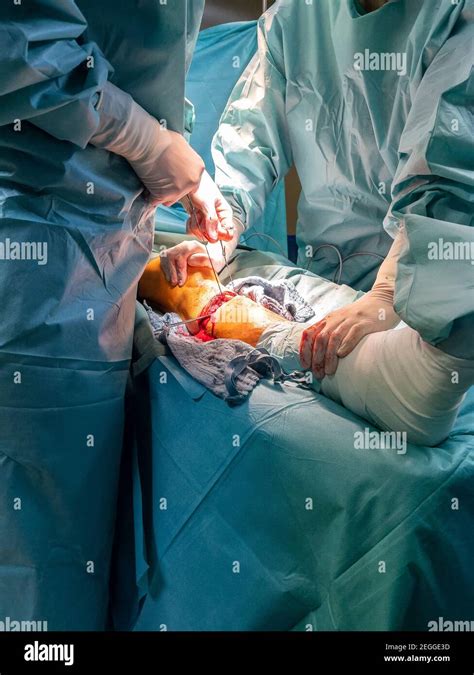 in an operating room lower leg amputation is performed Stock Photo - Alamy