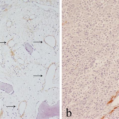 PDF Periostin Expression In Neoplastic And Non Neoplastic Diseases Of