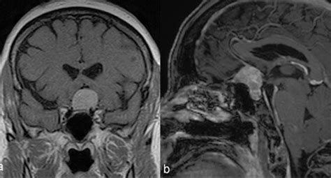 Picture Showing A Preoperative Mri Scan Showing The Case Of A