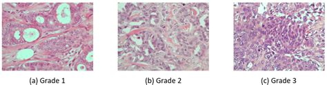 Three Hande Stained Breast Histopathological Microscopy Images From