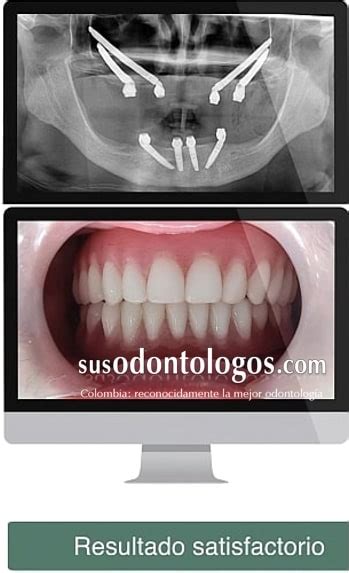 Implantes Cigomaticos Para Recuperar Toda Su Sonrisa SusOdontologos