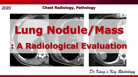 Lung Nodulemass A Radiological Evaluation Youtube