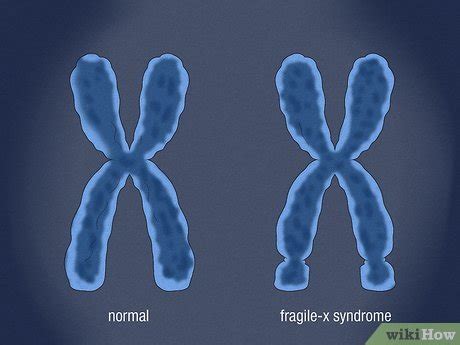 Recognizing Fragile X Syndrome Symptoms Genetics More