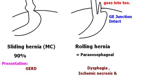 MedicoNotebook: Hiatus hernia