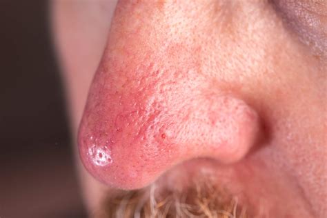 Was Hilft Gegen Rosacea An Der Nase Sanubiom