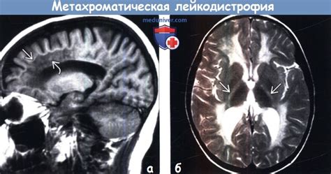 Диагностика метахроматической лейкодистрофии по КТ, МРТ головного мозга