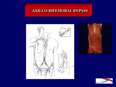 Ppt Pad Peripheral Arterial Occlusive Disease Powerpoint Presentation Id 1088942