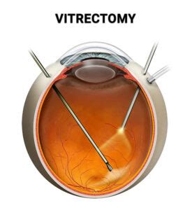 Vitrectomy Surgery Retina Specialists In New York