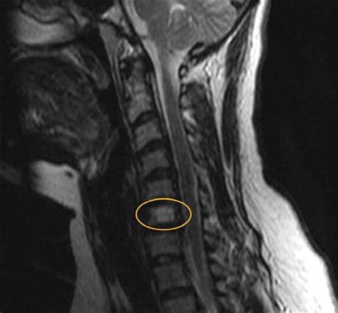 Coincidental Findings Of A Vertebral Hemangioma On Magnetic Resonance