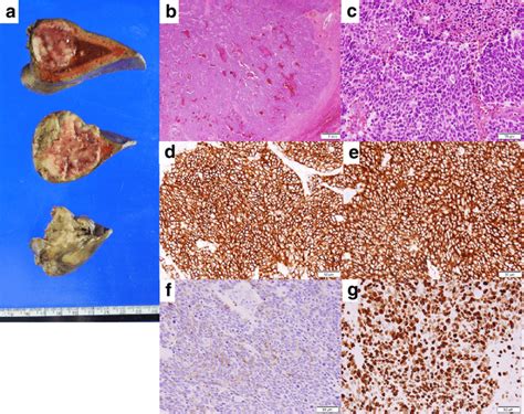 Macroscopic And Histopathological Findings Of The Resected Specimen A