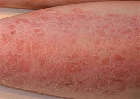 Psoriazis Manifestări Diagnostic Tratament